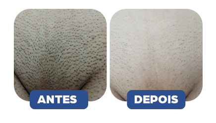 ANTES-E-DEPOIS-Clareador